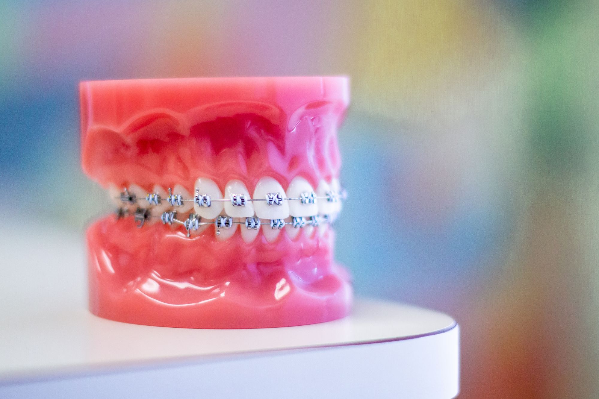 Surrey bc Metal braces