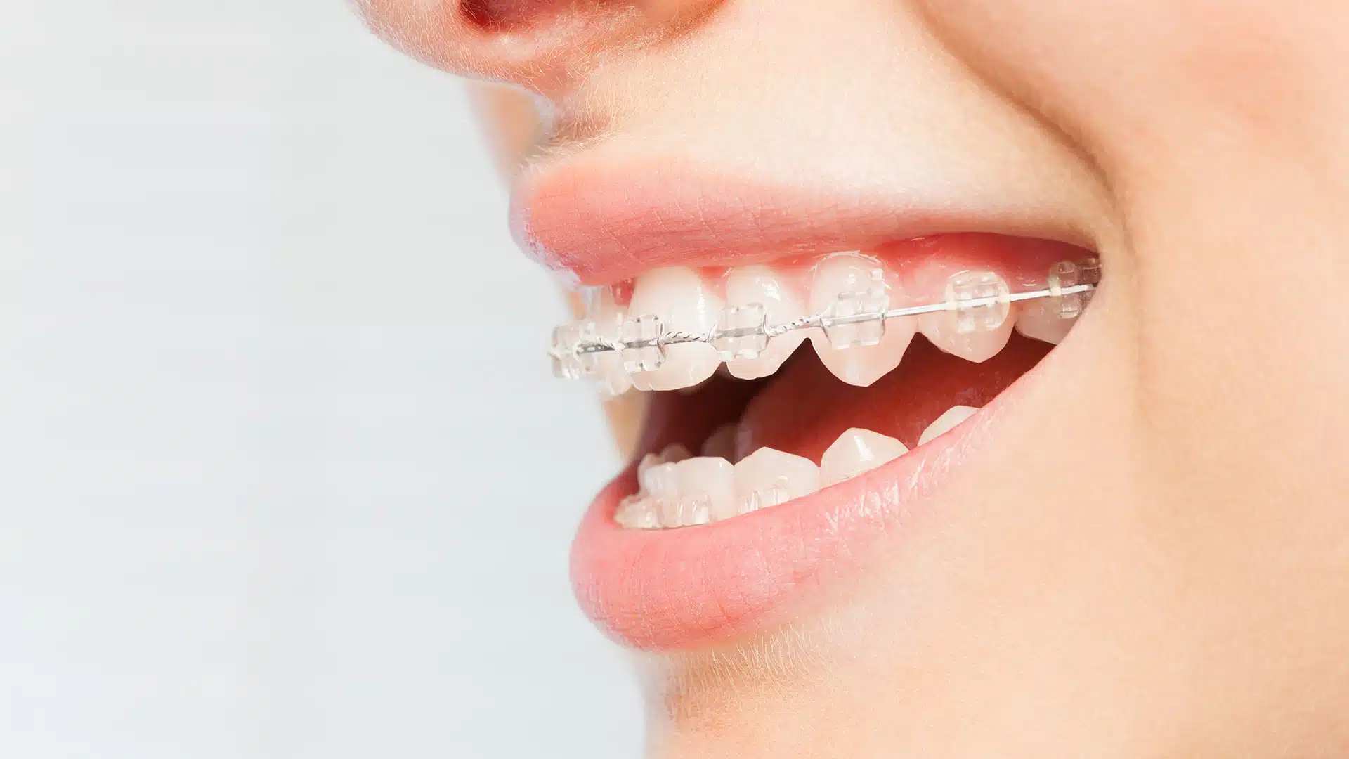 A close-up side view of a person smiling while wearing clear braces on their upper teeth.