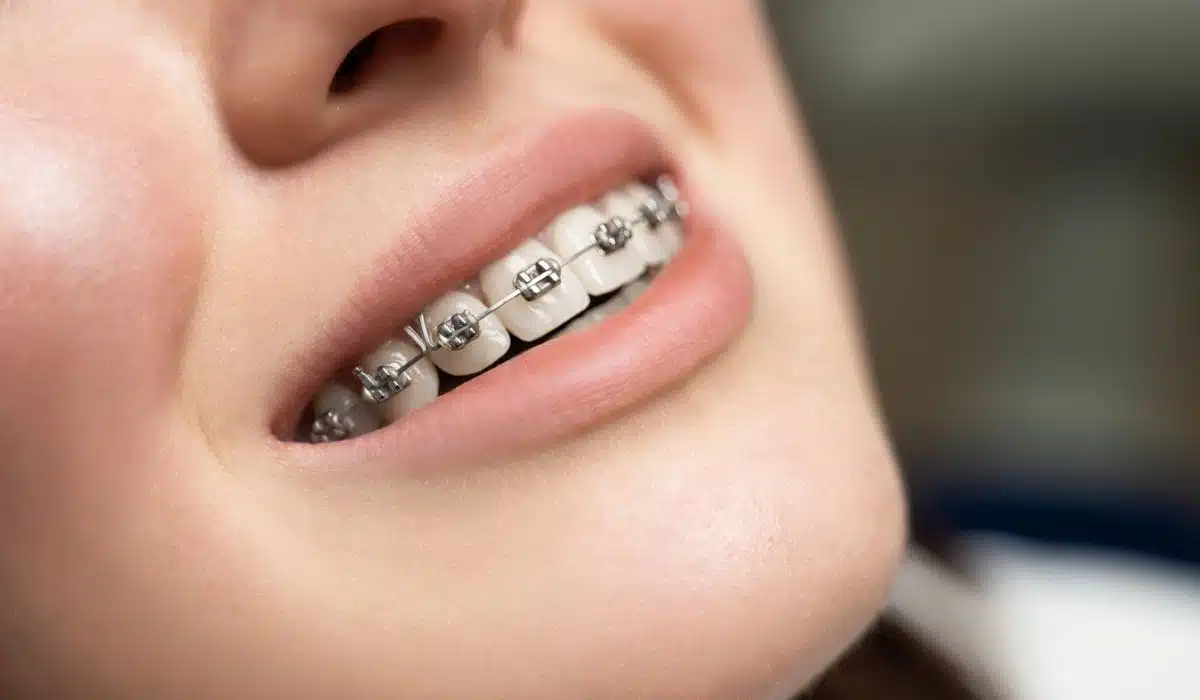 A close-up view of a person smiling and showing metal braces on their teeth.