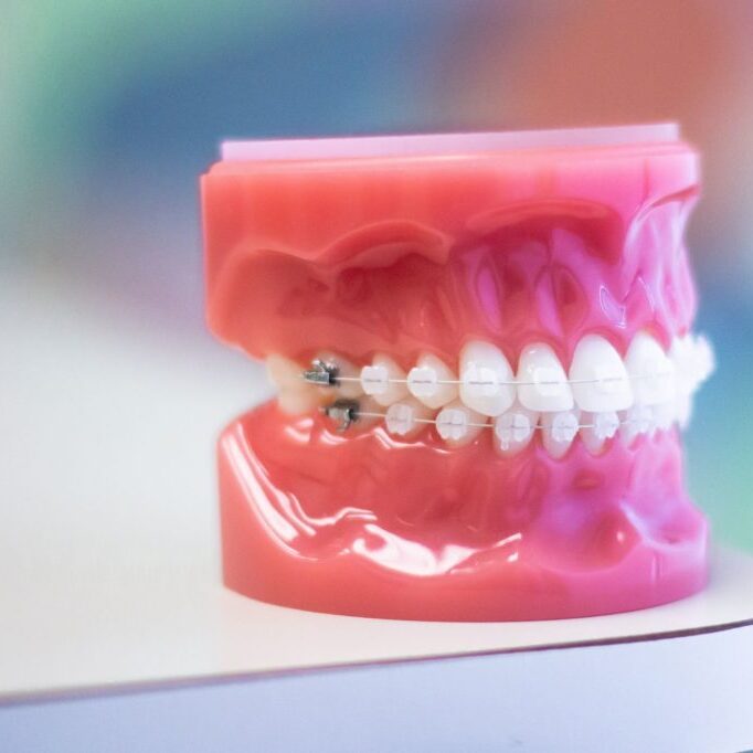 Braces South Surrey